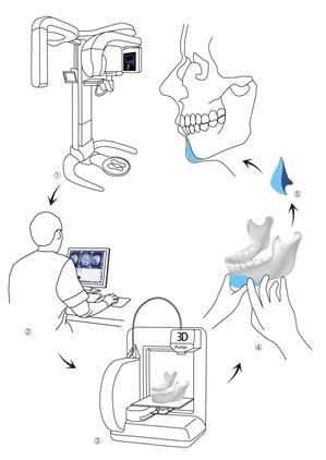 3D modeling & 수술 중  manual  implant 제작