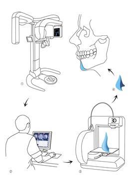 3D modeling & final  implant 제작