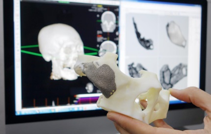 3D 프린터를 활용한 티타늄 광대 재건수술