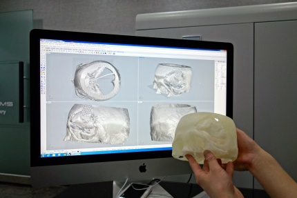 3D 프린터로 출력한 환자의 두개골 모형