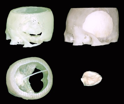 3D 프린터로 출력한 환자의 두개골 모형