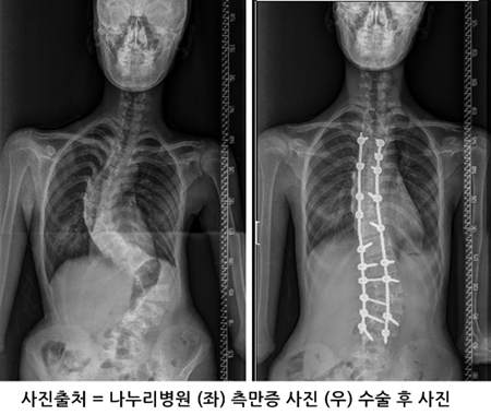 사진출처 = 나누리병원 척추측만증 수술 전과 후 사진 