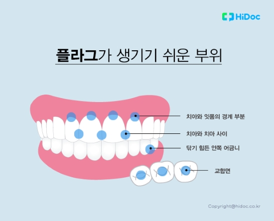 플라그가 생기기 쉬운 부위(치아와 잇몸 경계부분, 치아와 치아 사이, 닦기 힘든 안쪽 어금니, 교합면)