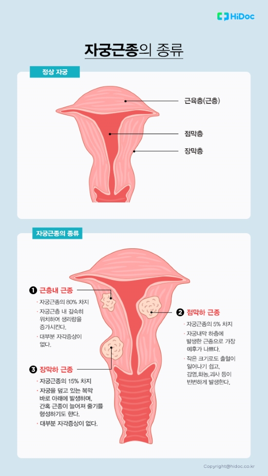 자궁근종의 종류