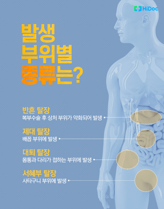 배에 볼록하게 만져지는 혹, 복벽탈장 왜 생길까?