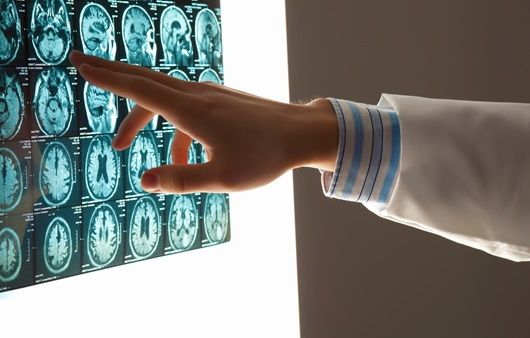 뇌혈관질환 뇌 검사 사진
