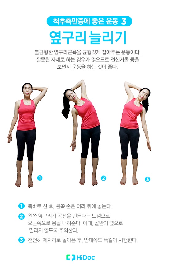 척추측만증