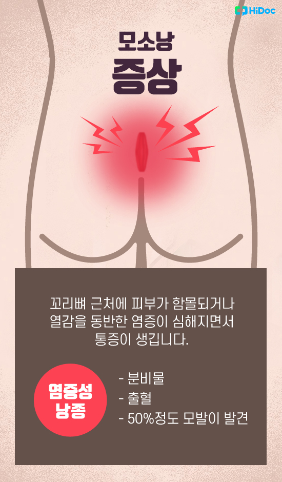 엉덩이 꼬리뼈가 아프고 염증이? ‘모소낭’ 