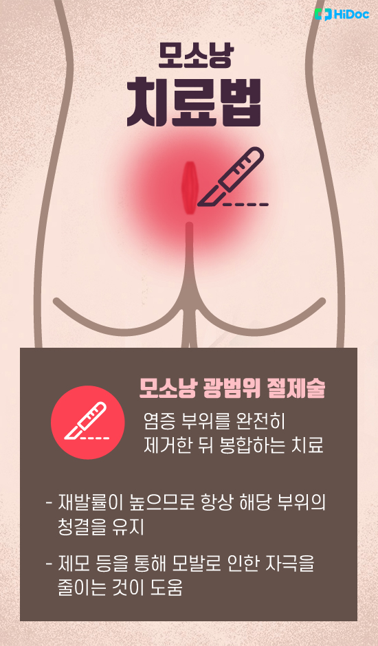 엉덩이 꼬리뼈가 아프고 염증이? ‘모소낭’ 
