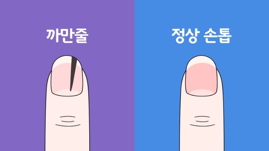 검은색 세로줄이 있는 손톱과 정상 손톱 모양