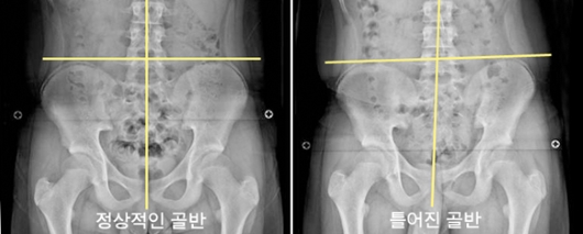 정상적인 골반과 틀어진 골반의 X-ray 검사 사진 (출처: 뽀빠이정형외과의원)