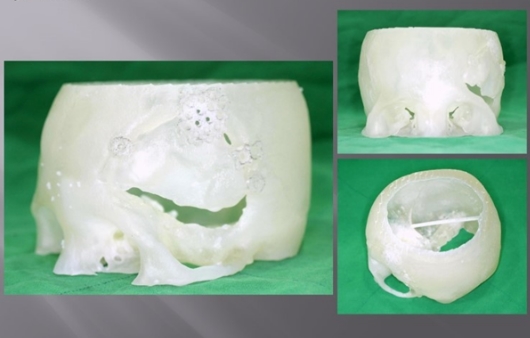3D프린터의 의학적 활용 ⑪ 두개골 재건 및 두상성형수술