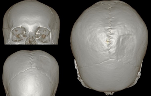 3D프린터의 의학적 활용 ⑪ 두개골 재건 및 두상성형수술