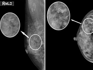 유방암으로진단받은환자의촬영사진