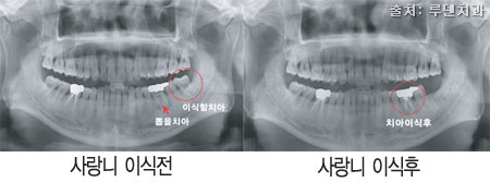 <마포구 사랑니 서울임플란트 2월 사랑니환자집 (Feat. 수면사랑니 수면임플란트)> 6