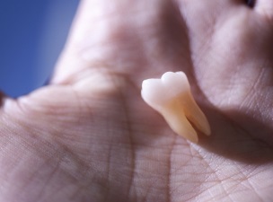 발치한 치아를 손 위에 올려놓은 모습
	