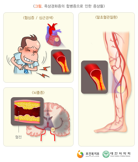 동맥경화의 원인 치료제 보충제 정보