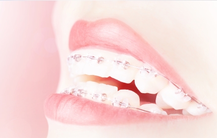교정 시작 전 알아 둘 치아교정 부작용과 예방법 5가지