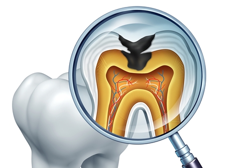 신경치료 한 치아는 반드시 씌워야 하나요?