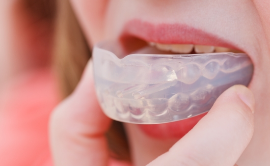 치아교정 후 ‘유지장치’의 관리와 기간