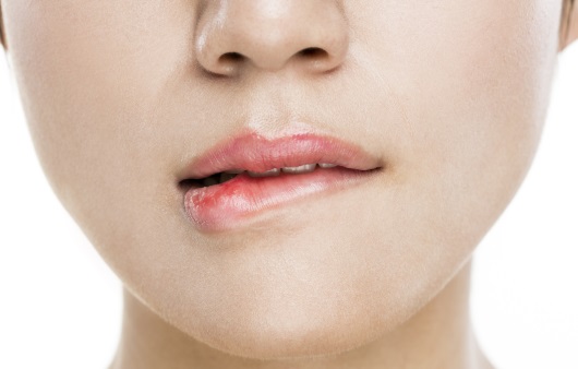 면역력 저하의 신호 ‘헤르페스’, 입술 포진과 물집