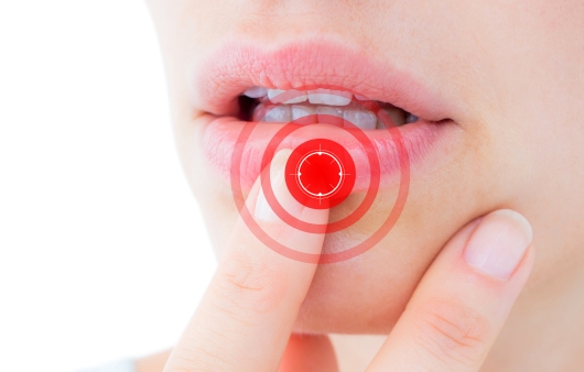 [1분 Q&A] 입술 물집·부어오름…단순포진 대처법은?