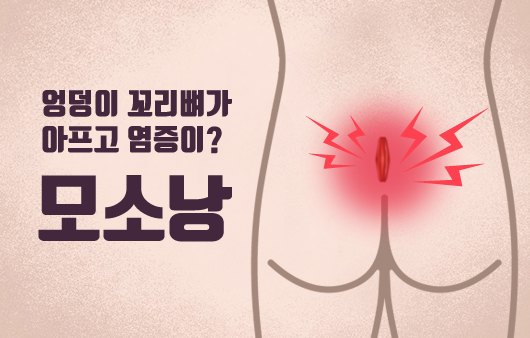 엉덩이 꼬리뼈가 아프고 염증이? ‘모소낭’ 원인