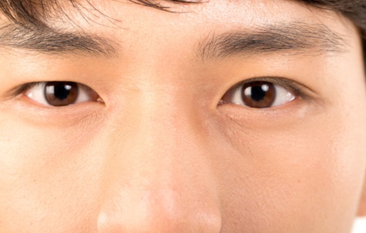 남성 눈매교정술, 비절개로 할 수 있을까?