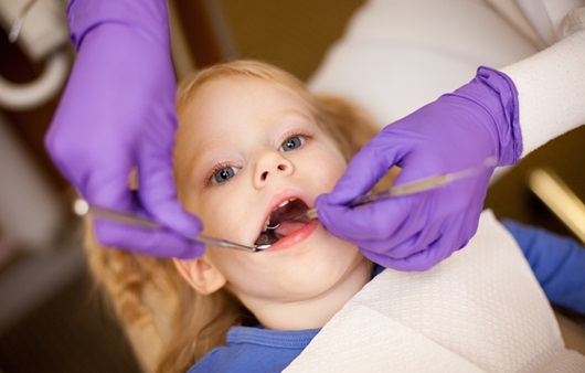 치아 홈메우기로 불리는 ‘소아 실란트’ 치료란 무엇일까?