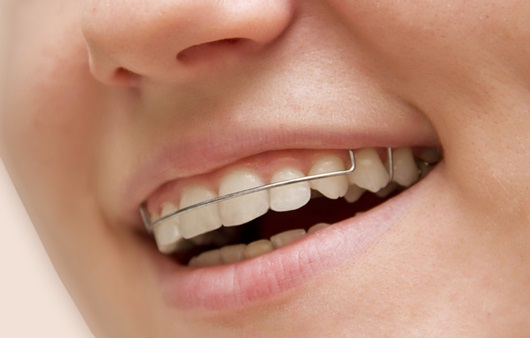 치아 교정 후 유지 장치는 언제까지 해야 할까?