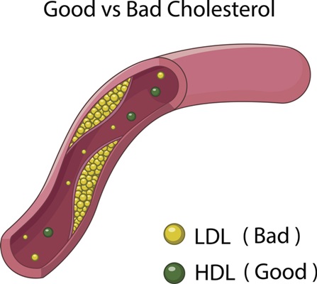 착한 HDL 콜레스테롤과 나쁜 LDL 콜레스테롤