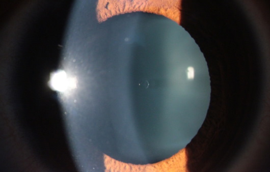 △ 사진 = 중앙 구멍(central hole)방식 ICL 삽입 후 모습, 서창밝은안과의원 제공