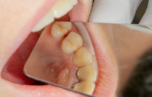 치과에서 치료 안 하는 충치가 있다? ‘정지우식’이란?