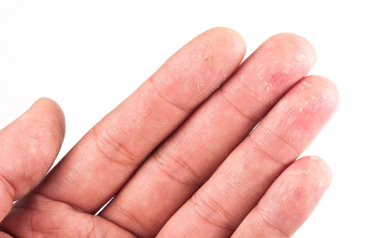 한포진 증상 내버려두면 손톱, 발톱 빠질 수 있다?
