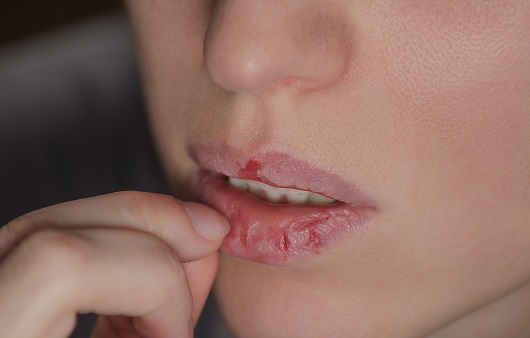 입술의 각질을 뜯는 습관은 구내염 발생 위험을 높인다