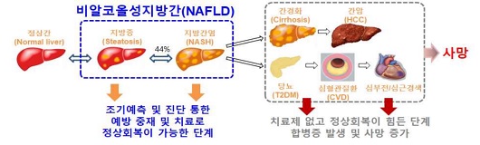 비알코올 지방간질환 범위 및 예후