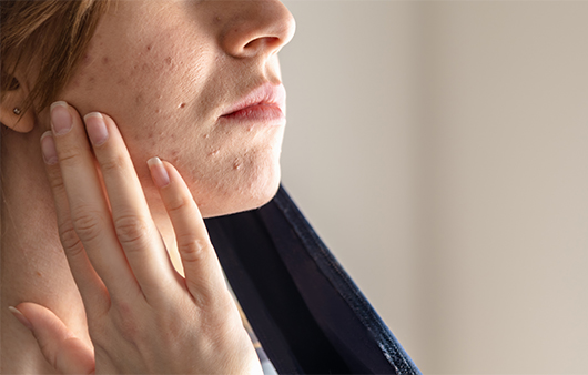 마스크 사용으로 인해 피부 트러블을 겪는 사례가 늘고 있다