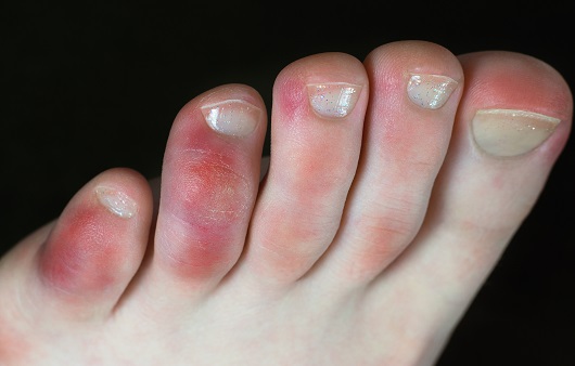 코로나19의 후유증으로 알려졌던 ‘코로나 발가락(covid toe)’의 원인을 밝혀냈다