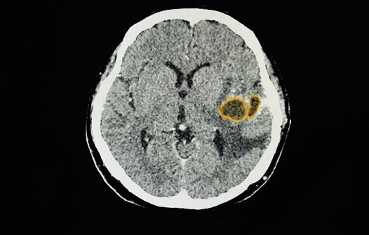 뇌농양 환자의 뇌 CT