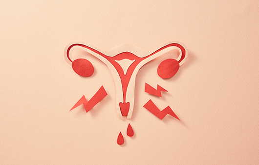 자궁내막증 있으면 유산 위험이 커질까?