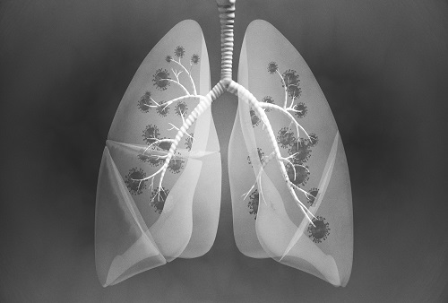 폐 질환