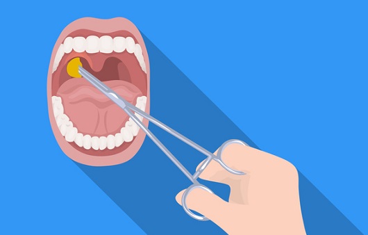 '목에서 나는 똥' 편도결석, 널 어쩌면 좋니...원인부터 제거까지