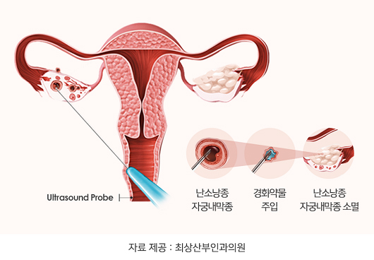난소에 생기는 혹, 난소낭종… 임신, 여성호르몬과의 관계는?