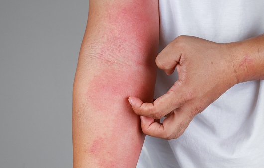 더운 여름 피부를 괴롭히는 아토피피부염...효과적인 관리 방법은?