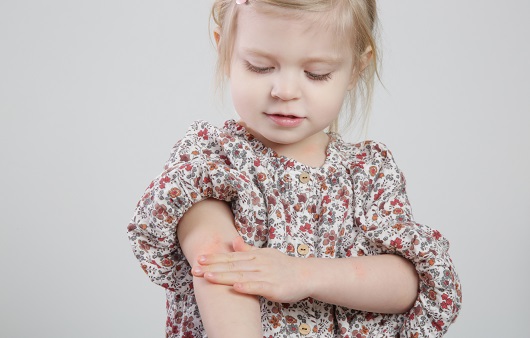 아토피피부염이 어린아이의 정신 건강에 영향을 줄 수 있다