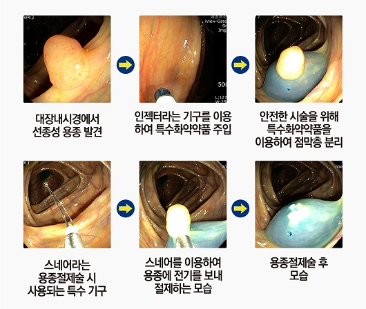 용종절제술ㅣ출처: 마천내과의원