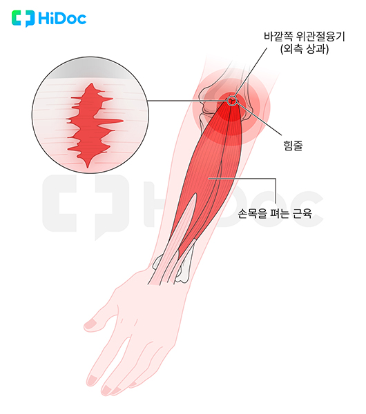 테니스 엘보ㅣ출처: 하이닥