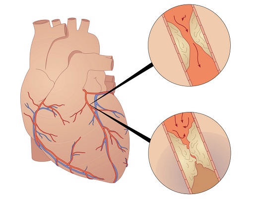 관상동맥이 좁아진 상태(위)와 완전히 막힌 상태(아래)ㅣ출처: 클립아트코리아