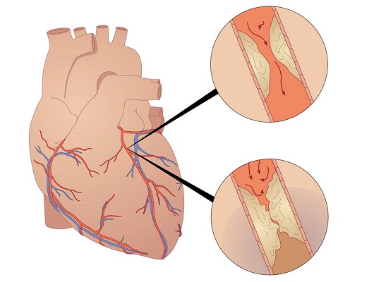 심장 혈관 좁아지게 하는 원인 6...그래서 발생하는 '협심증'
