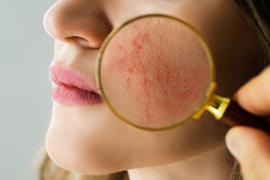 대인기피증 유발하는 지루성피부염과 안면홍조, 어떻게 대처할까?